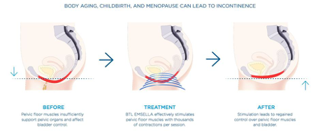 Emsella before, during and after treatment illustration