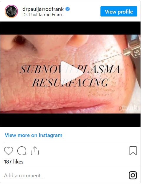 Subnovii Plasma Resurfacing video by Dr. Paul Jarrod Frank of PFRANKMD in New York City, NY