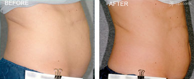 liposonix before and after