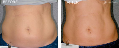 liposonix before and after