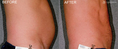 Liposonix treatment image - March 2022
