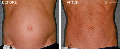 liposonix before and after