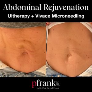 vivace radiofrequency microneedling before and after