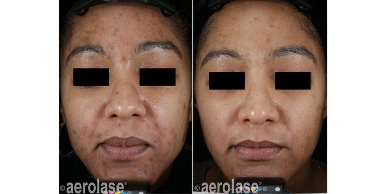 aerolase before and after