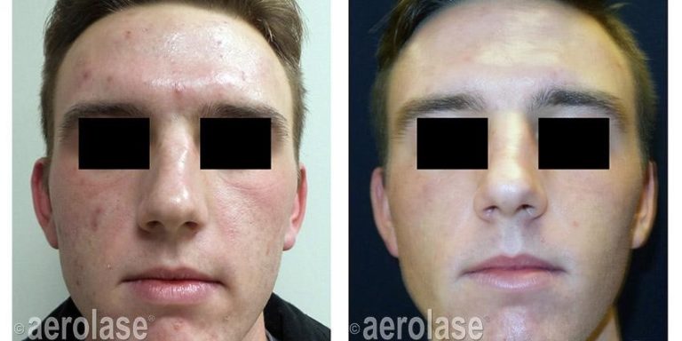 Before and after results of acne scarring treatment
