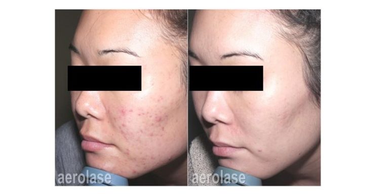 aerolase before and after