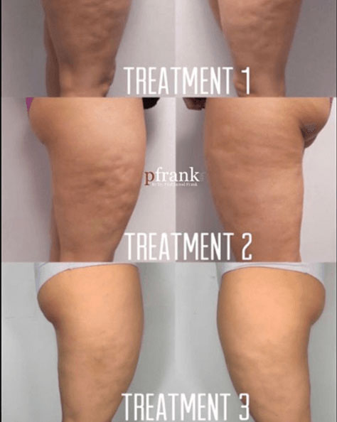 BIOSTIM Before and After photo by Dr. Paul Jarrod Frank of PFrankMD in New York City, NY