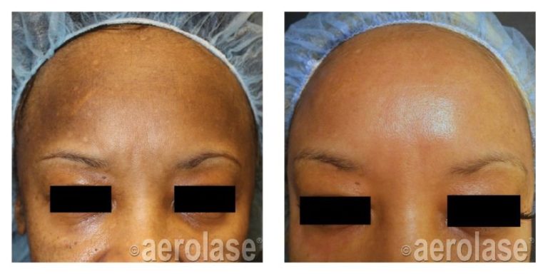 aerolase before and after