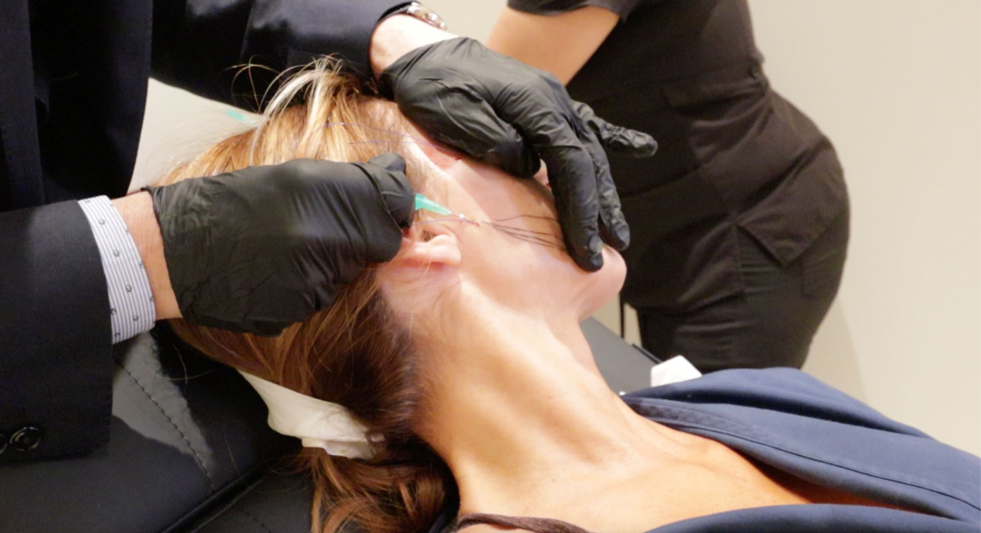 Woman with lines drawn on face for threadlift