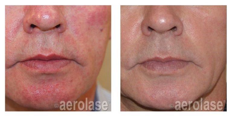 aerolase before and after