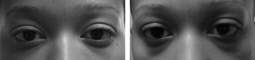 Hyperpigmentation Before and After photo by Dr. Paul Jarrod Frank of PFRANKMD in New York City, NY