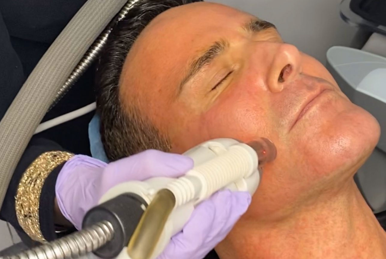 Male during Fraxel Resurfacing 