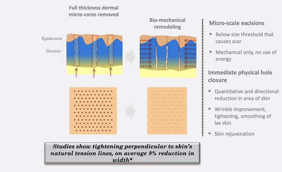 Skin tightening infographics