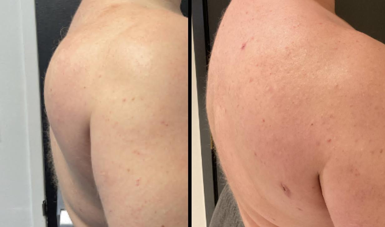 Lipomas Before and After photo by Dr. Paul Jarrod Frank of PFRANKMD in New York City, NY