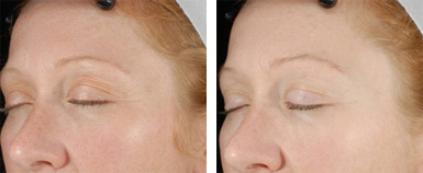 Ultherapy Before and After photo by Dr. Paul Jarrod Frank of PFRANKMD in New York City, NY