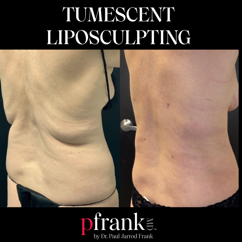 Tumescent Liposculpting - PFrank MD