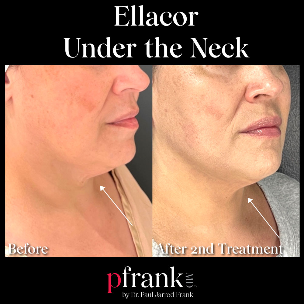 Ellacor before and after results - October 2022
