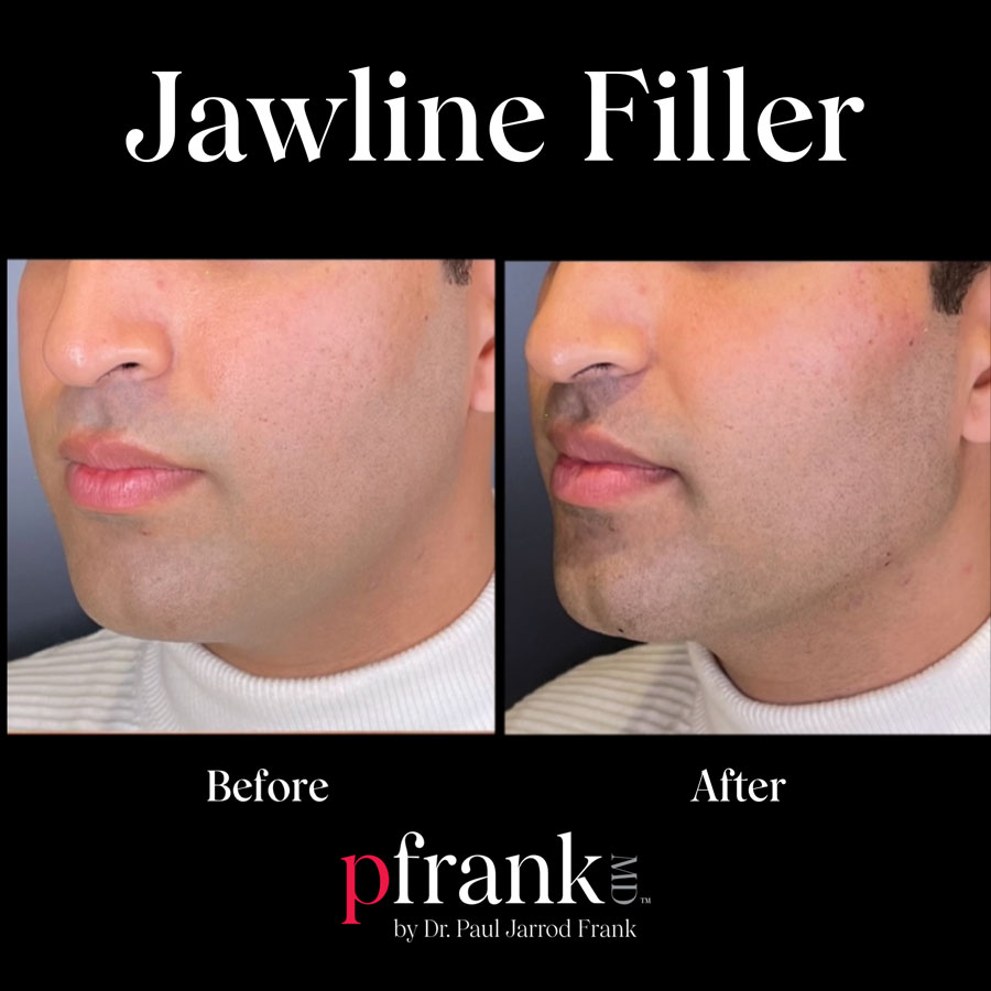 Jawline Filler Before and After