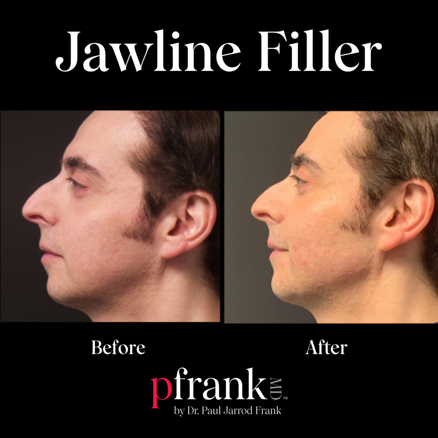 Jawline Filler Before and After