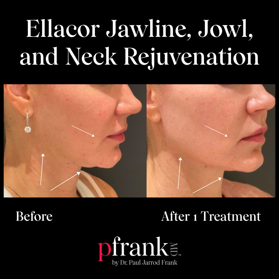 Ellacor treatment for jawline - November 2022