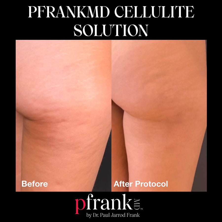 Cellulite Solution Before and After