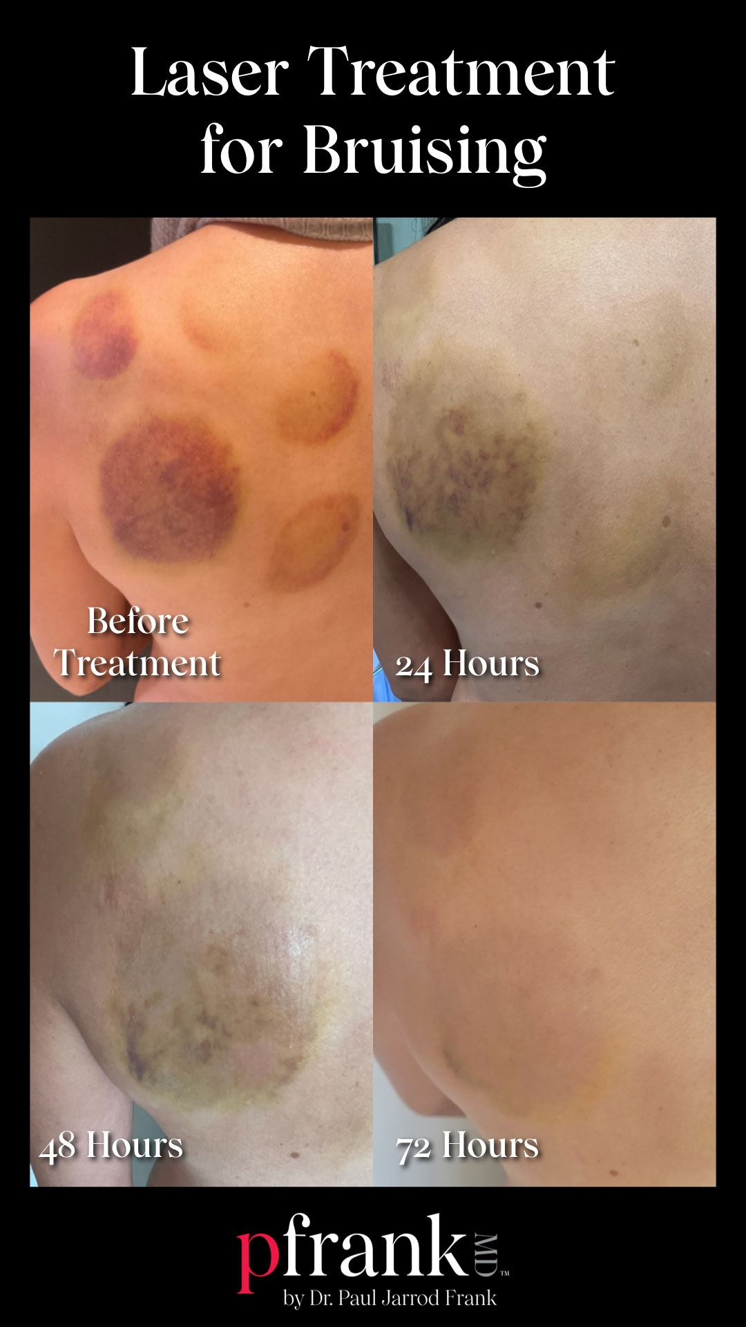 pfrank - vbeam before & after