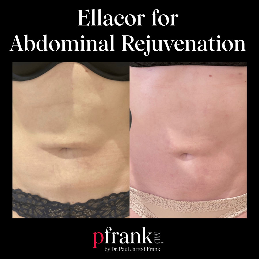 ellacore before and after