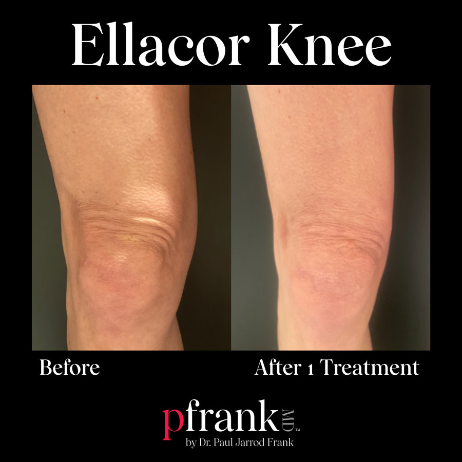 Ellacor treatment for knee wrinkles - April 2023