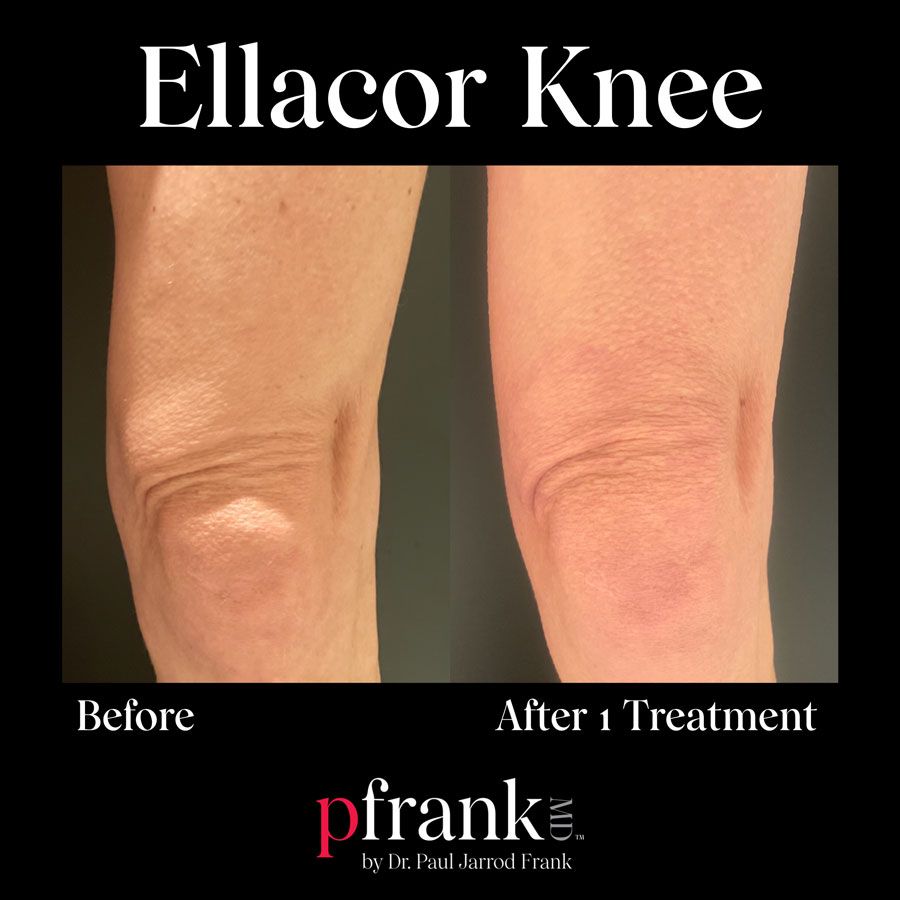 Ellacor treatment for knee wrinkles - April 2023