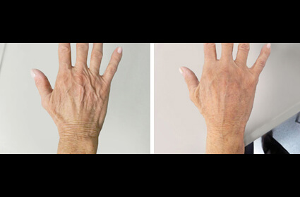 Aging Hands Before and After Results