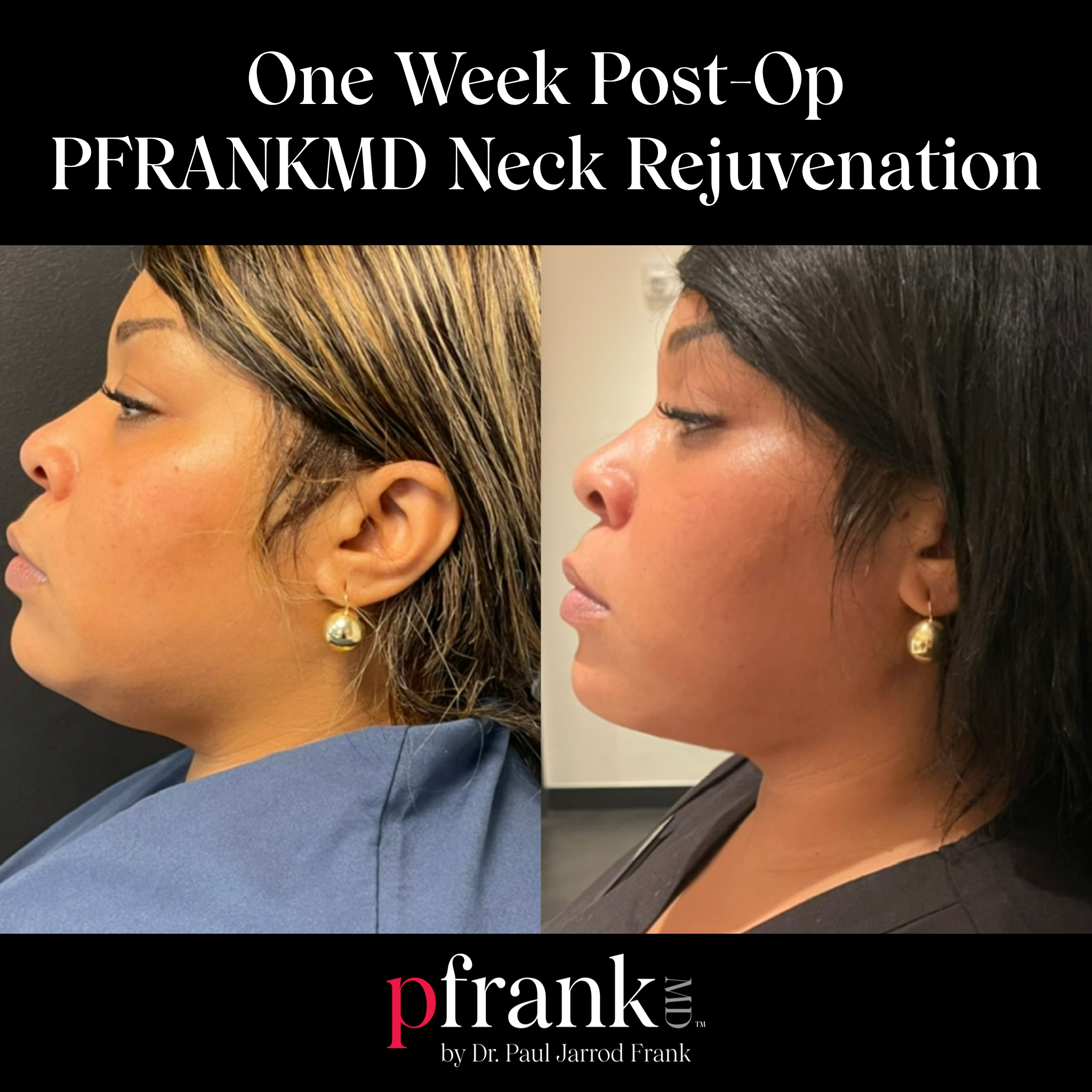 neck rejuvenation before and after