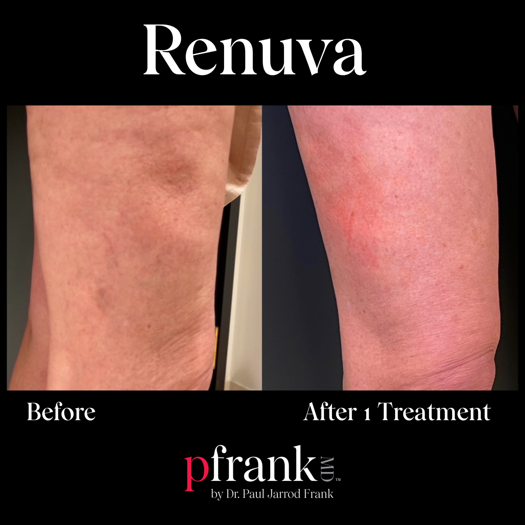 Renuva treatment for legs - May 2023