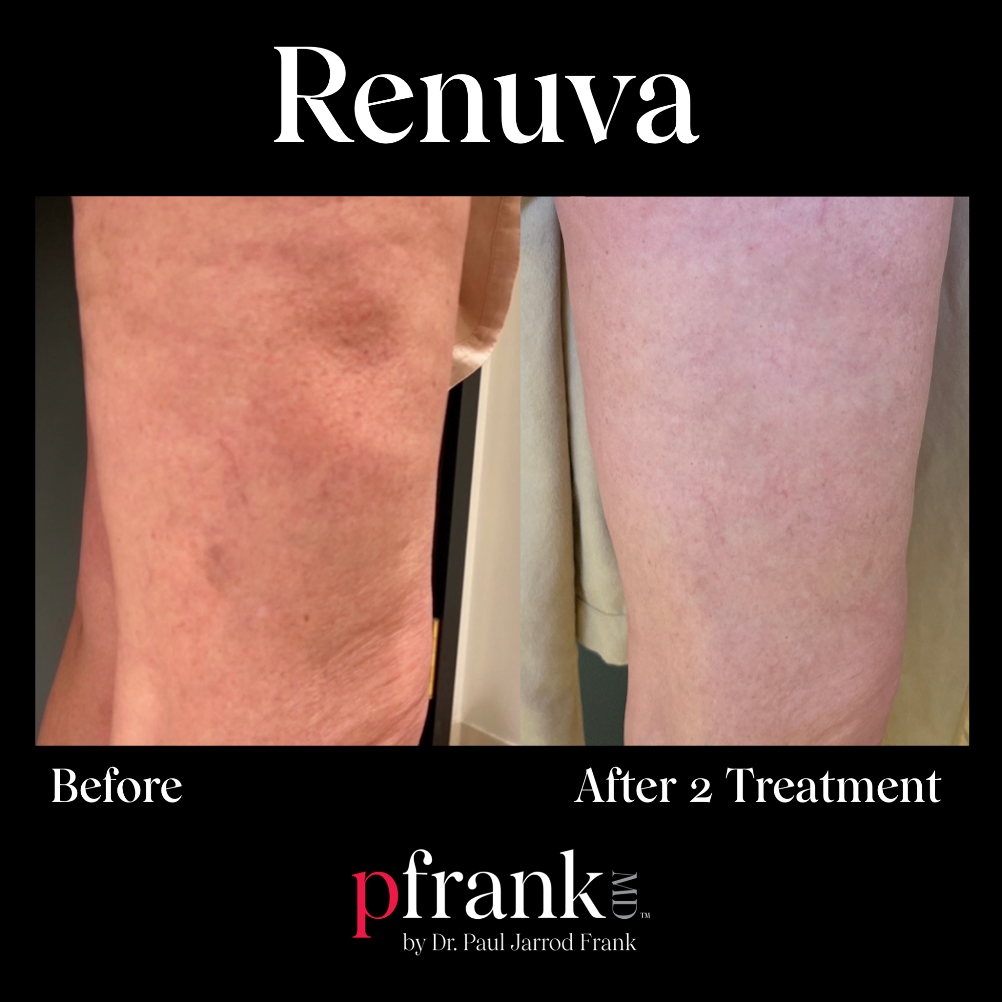 Renuva treatment before and after - May 2023