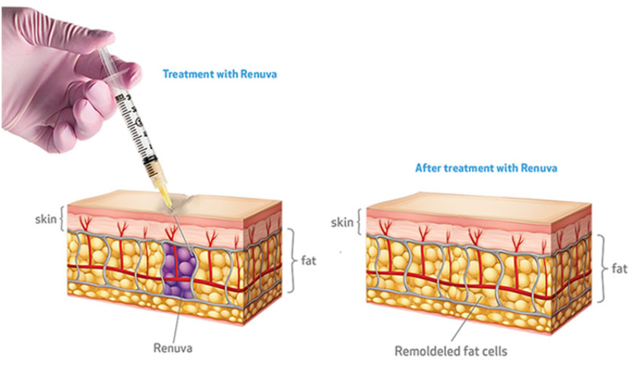 renuva info graphic