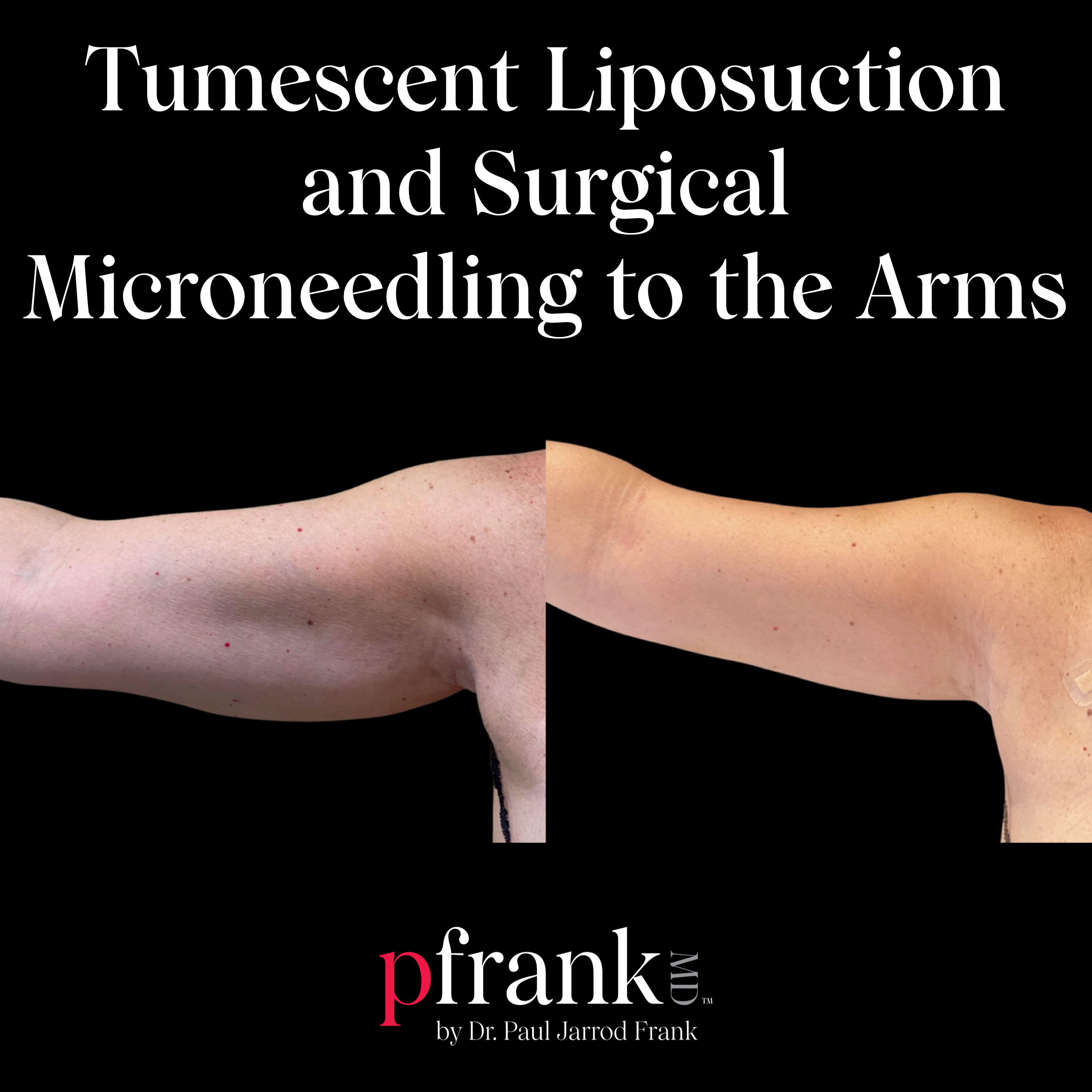 Arm liposuction before and after - June 2023