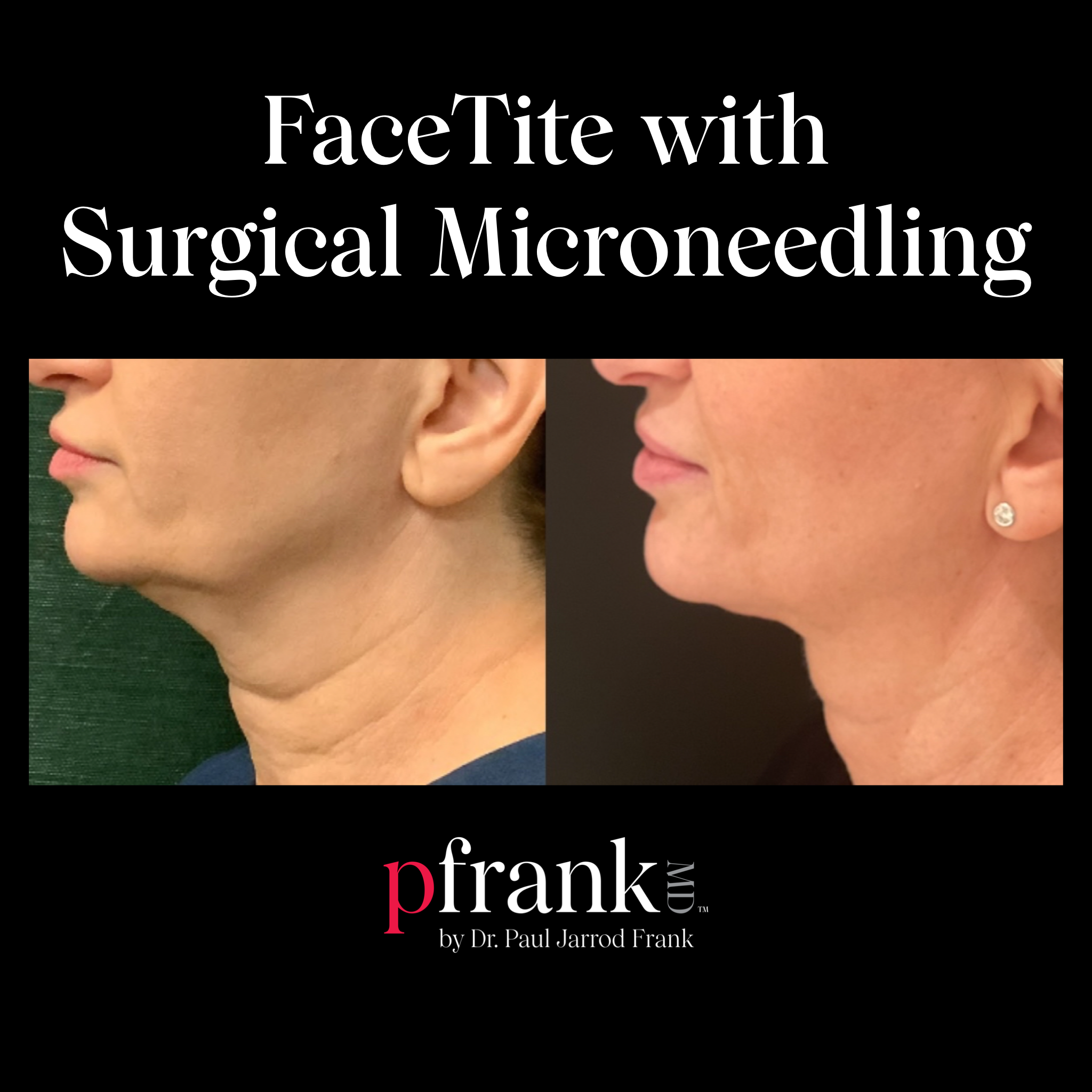 Facetite with Surgical Microneedling Before and After Results