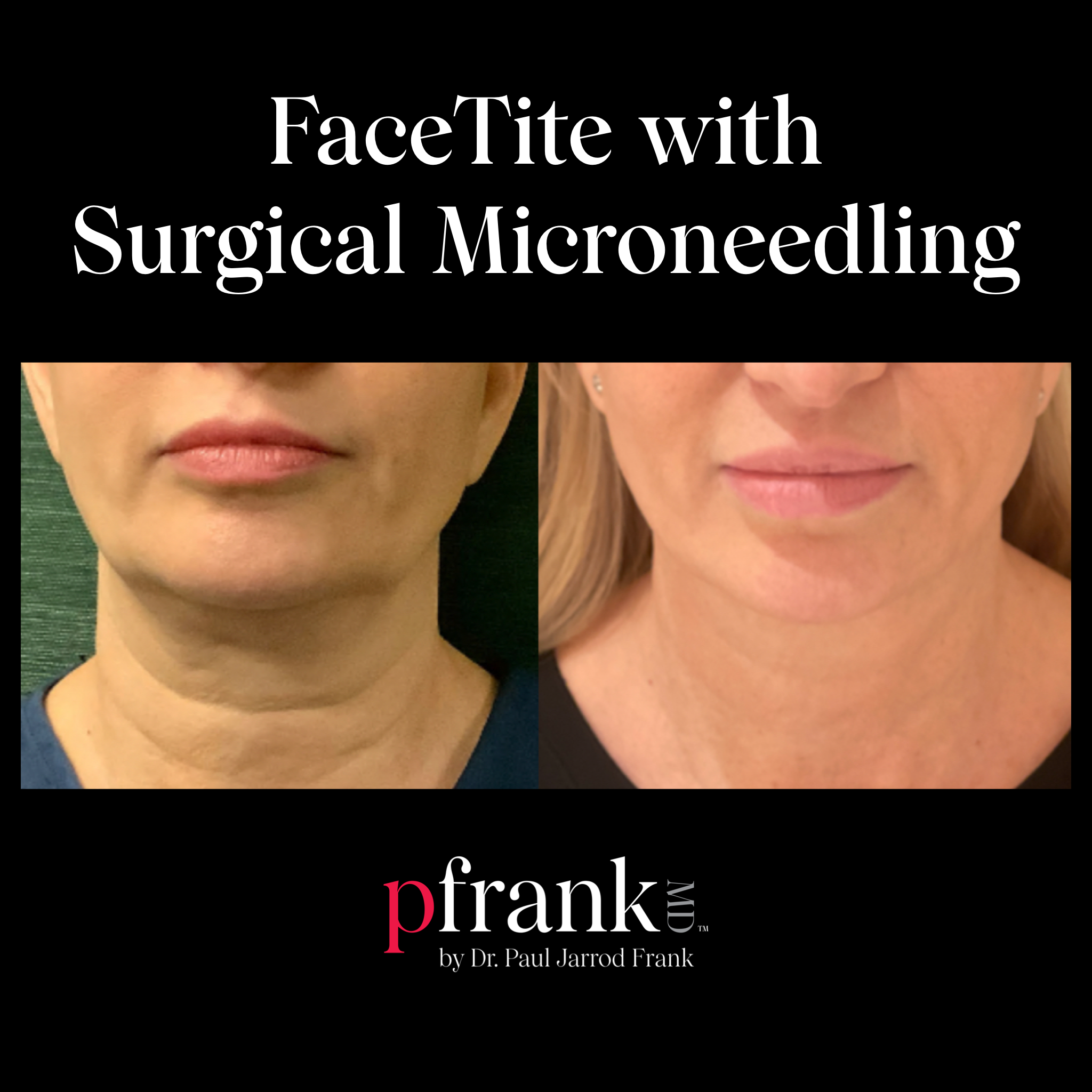 Facetite with Surgical Microneedling Before and After Results