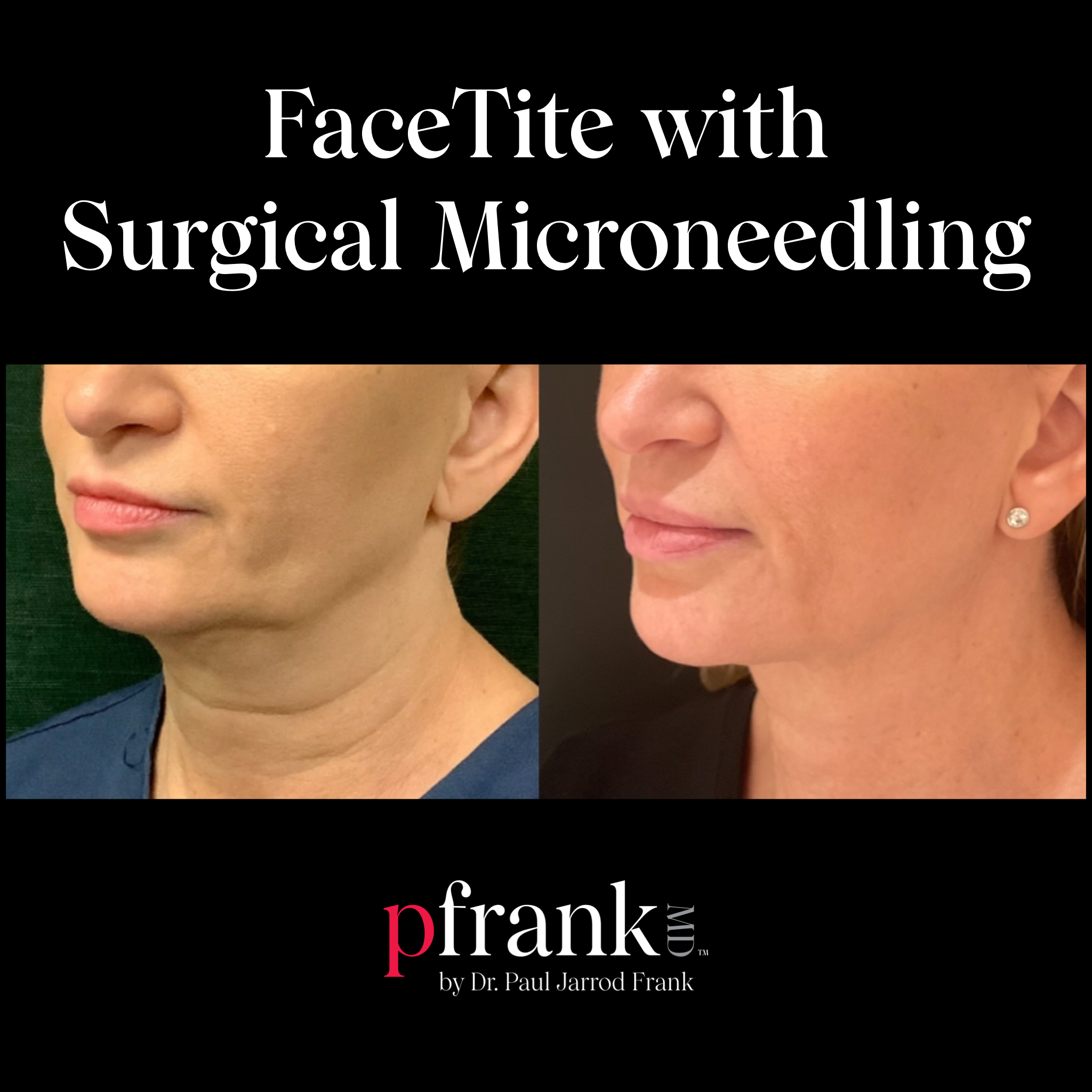 FaceTite treatment before and after - June 2023