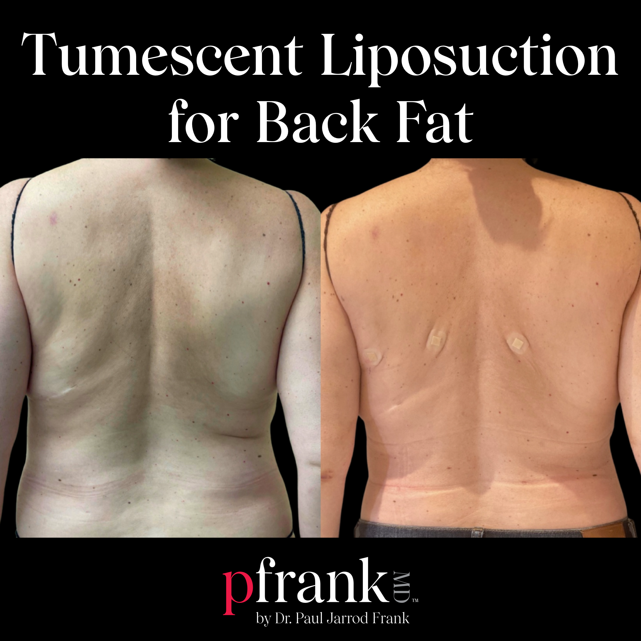Tumescent Liposuction Back Fat Before and After New York City