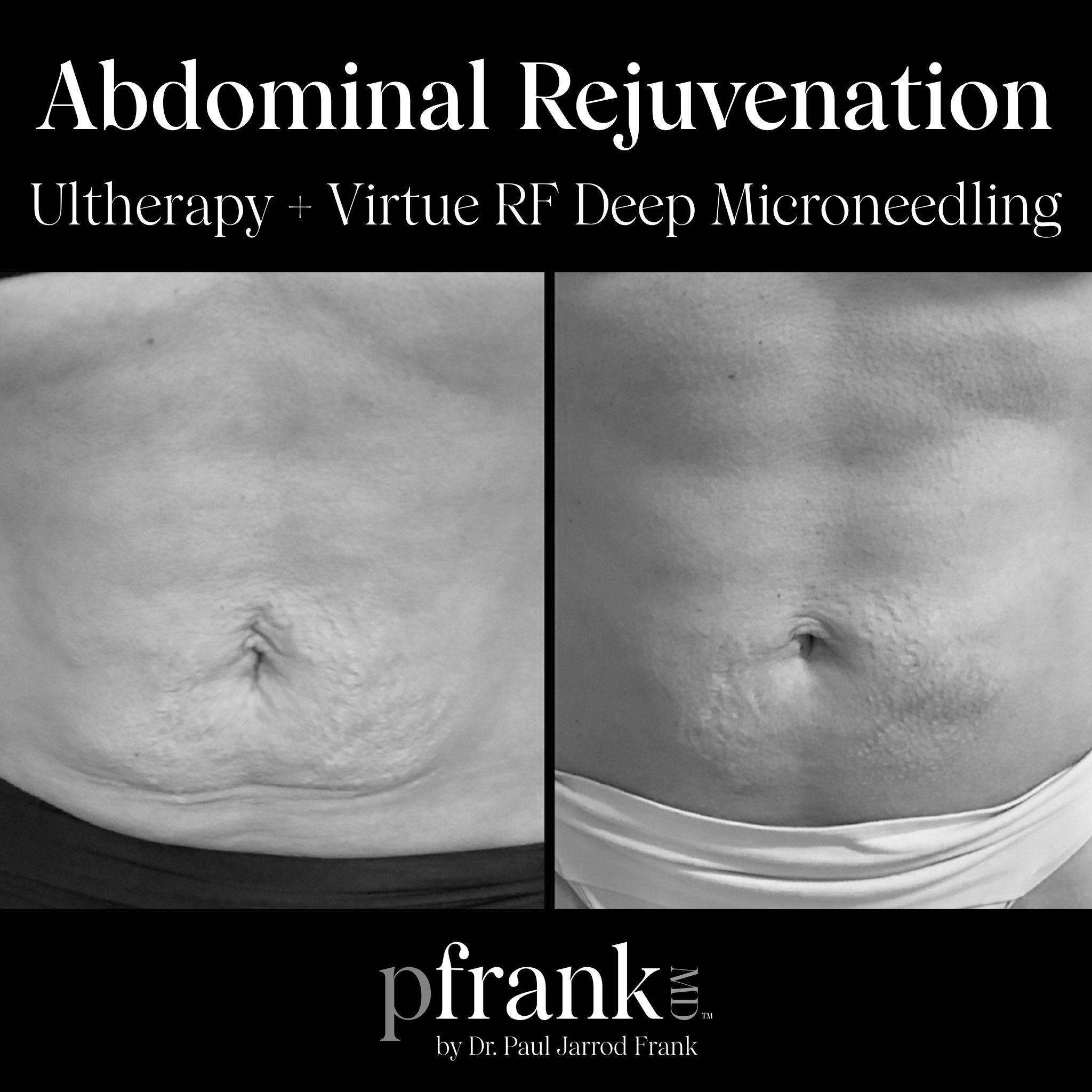 body microneedling before and after