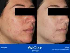 AviClear treatment before and after - September 2023