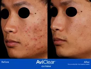 AviClear treatment results - Before and after - September 2023