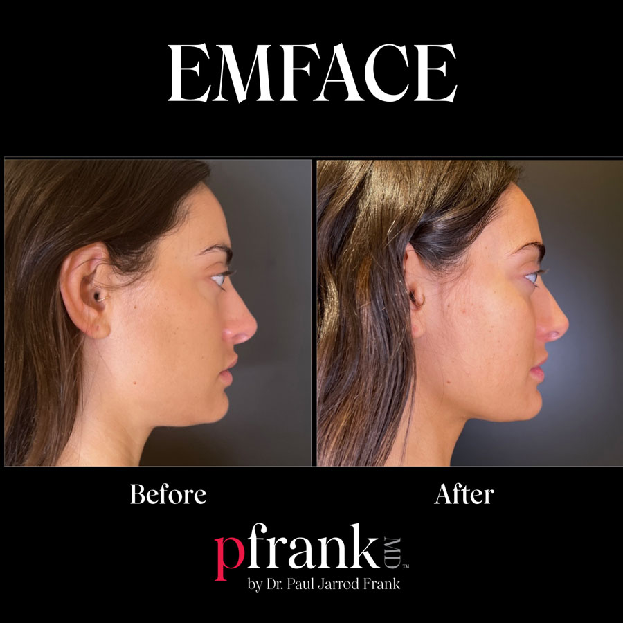 EMFACE before and after