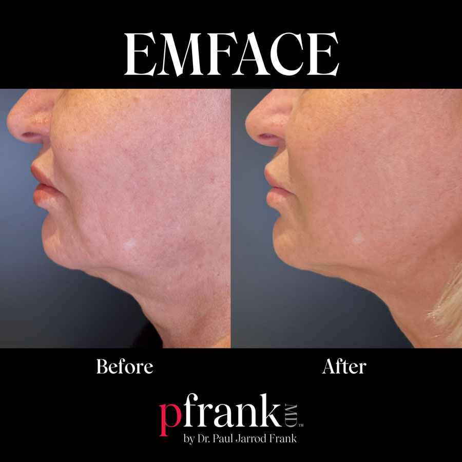 EMFACE before and after