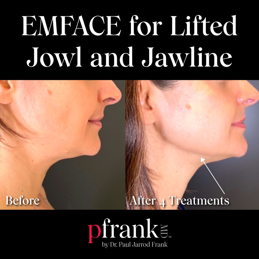 EMFACE before and after
