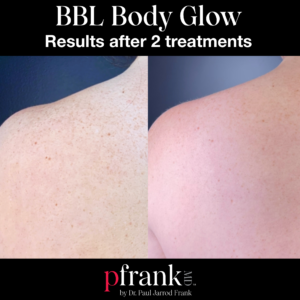BBL Body Glow before and after
