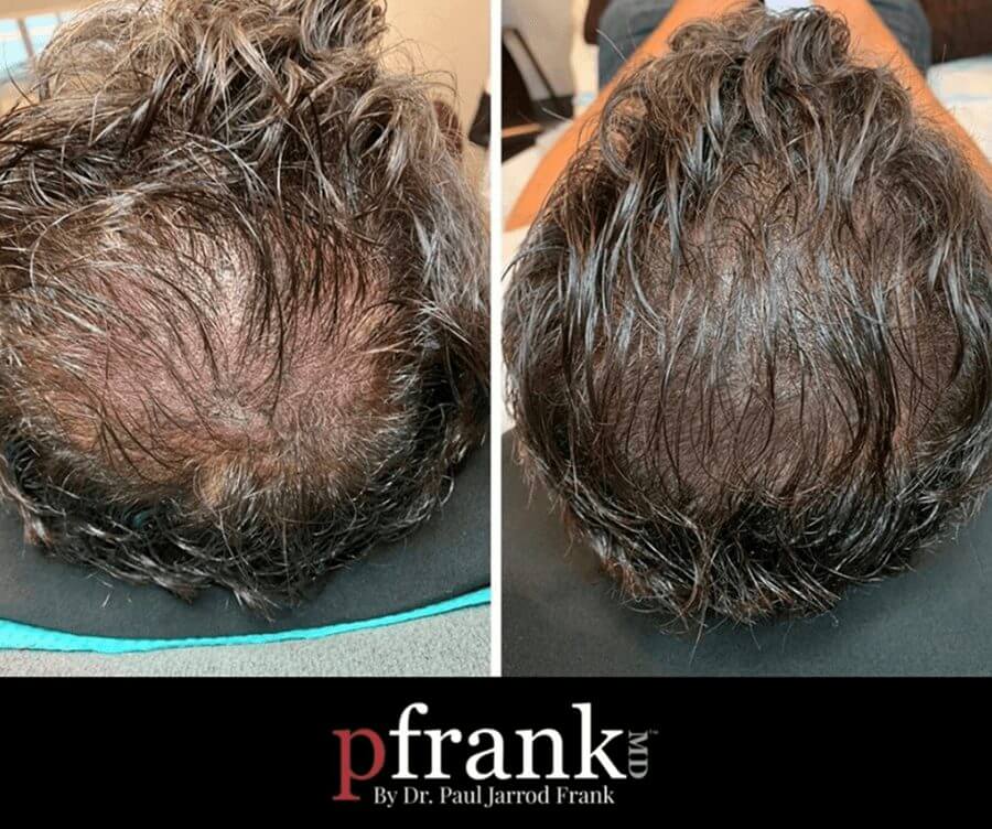 scalp treatment before and after