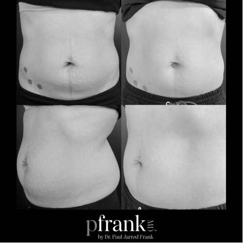 body microneedling before and after