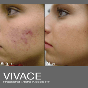 vivace radiofrequency microneedling before and after