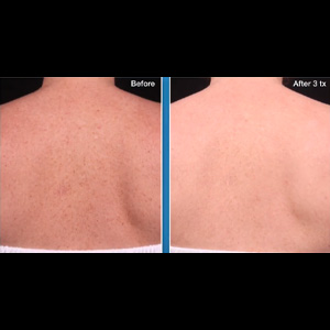 BBL Body Glow before and after